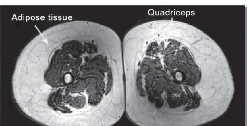 Muscle loss: cat scans of